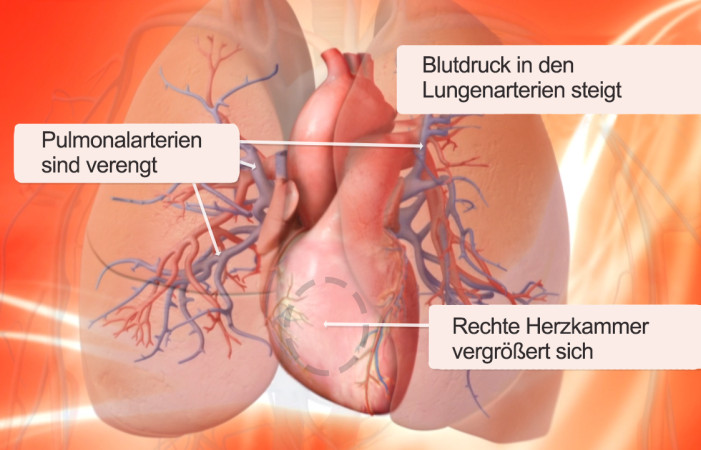 Lungenhochdruck Grafik (Foto: Bayer Vital)