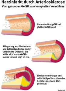 Herzinfarkt durch Arteriosklerose - Abbildung