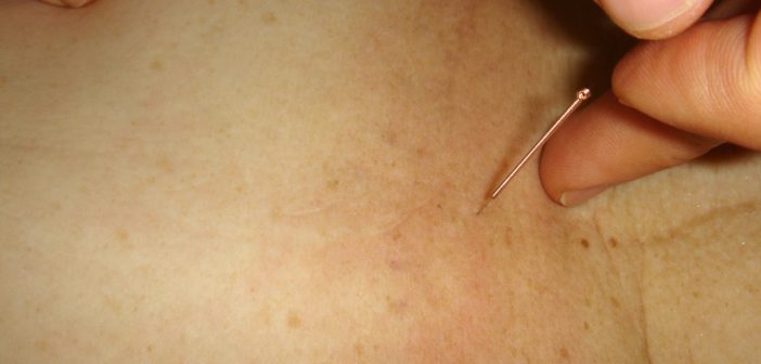 Wie Akupunktur bei Migräne helfen kann
